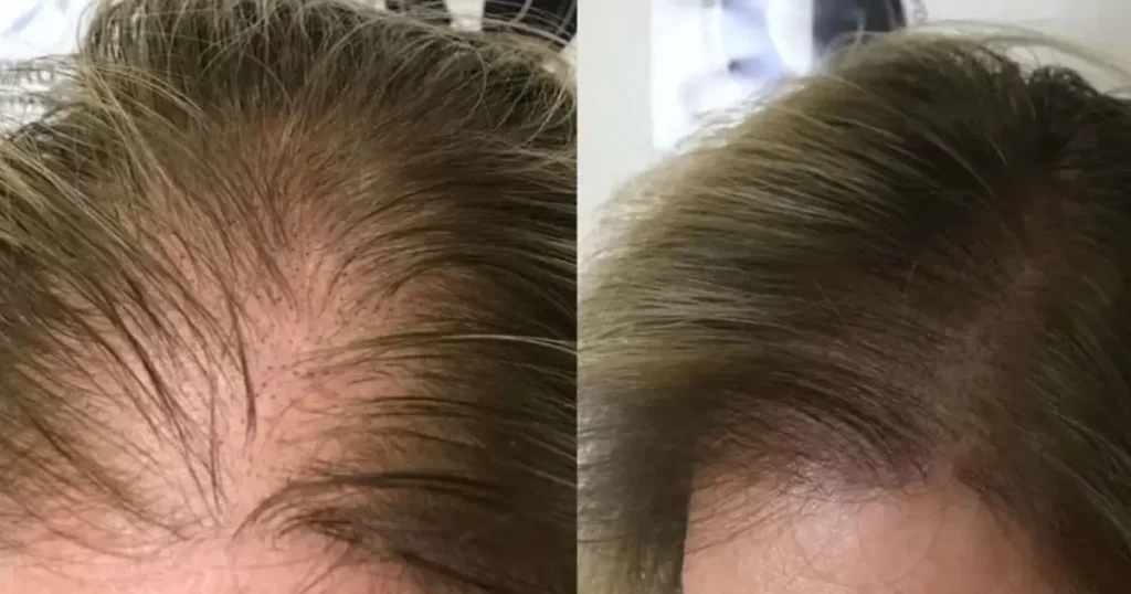 What Is Scalp Micropigmentation